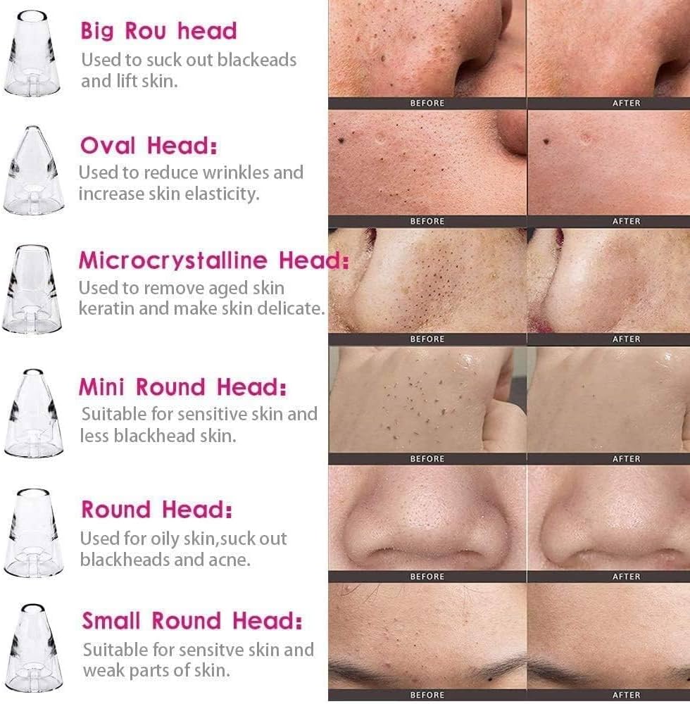 Blackhead Remover Vacuum – Deep Pore Cleaner