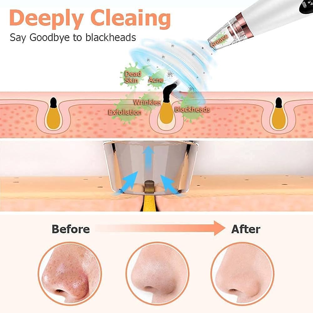 Blackhead Remover Vacuum – Deep Pore Cleaner
